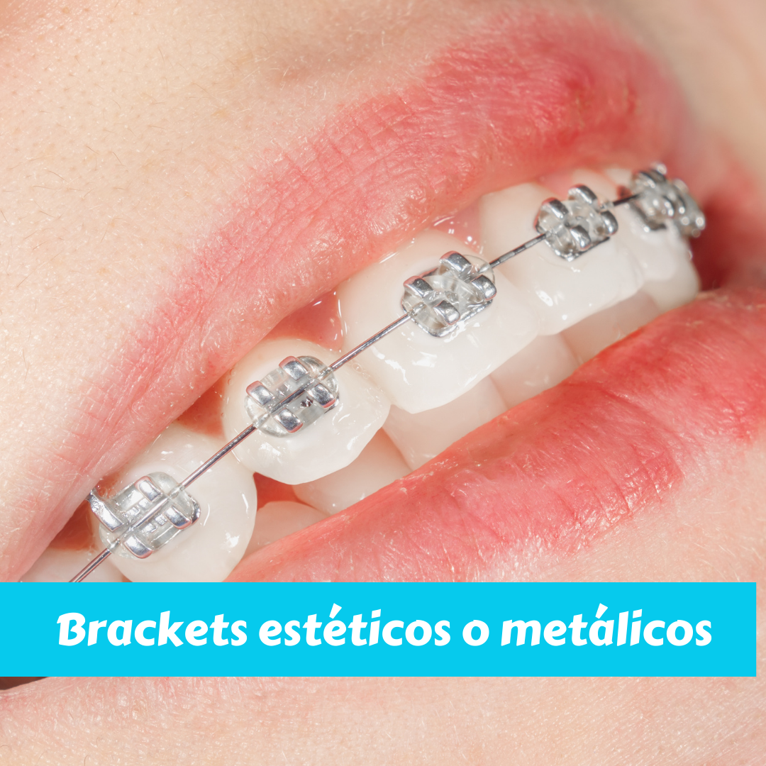 Brackets estéticos o metálicos