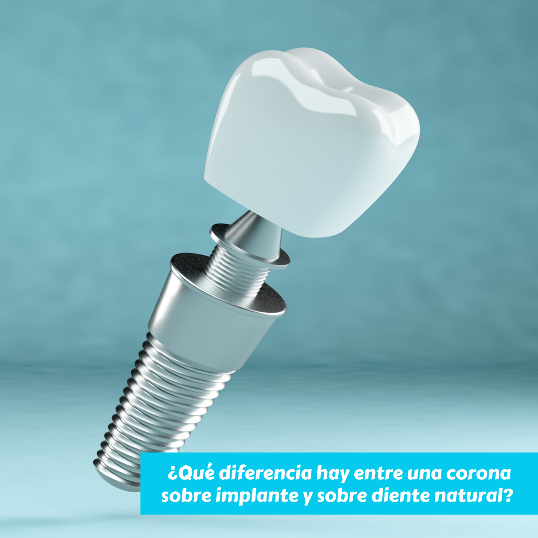 ¿Qué diferencia hay entre una corona sobre implante y sobre diente natural?